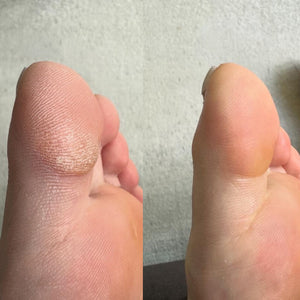 Elektrisk fotfil for förhårdnader og torra føtter